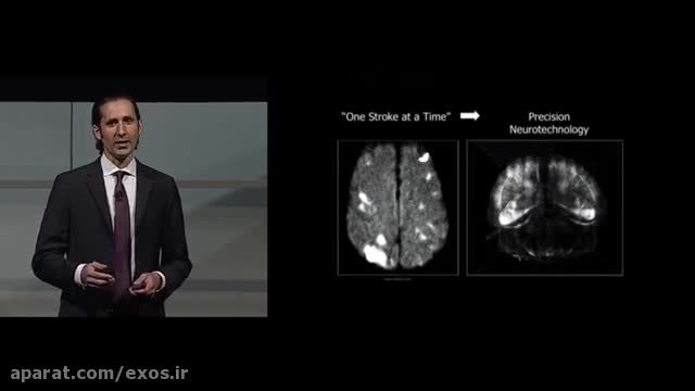 اتصال مستقیم دست مصنوعی به مغز و بازگشت حس لامسه