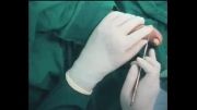 جراحی اکسیزیون(کشیدن)ناخن شست پا- دکتر پیوند علامه