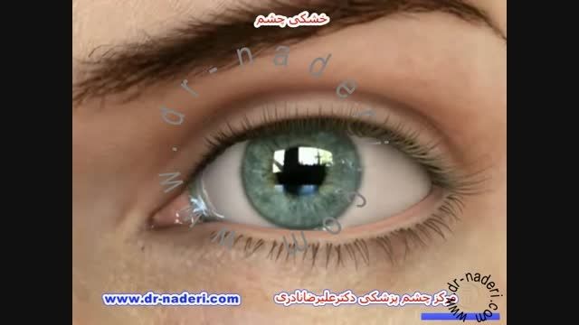 خشکی چشم - مرکز چشم پزشکی دکتر علیرضا نادری
