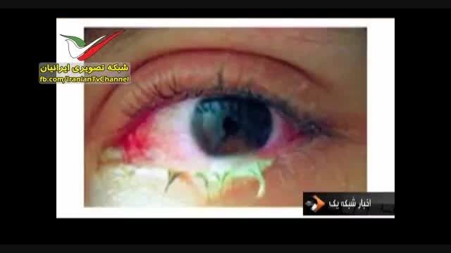 کشته شدن دختر ایرانی بر اثر استفاده از لنز تقلبی