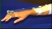 Radial Nerve Palsy Splint