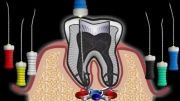 درمان ریشه ی دندان ، عصب کشی