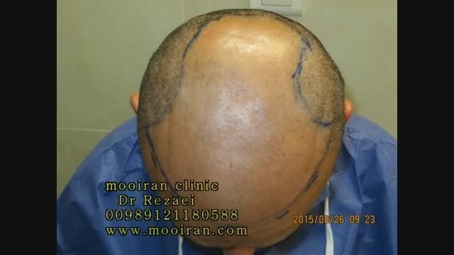 +12 کاشت مو  به روش ترکیبی در کلینیک دکتر رضائی روز عمل