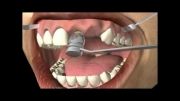 ایمپلنت دندانی چیست؟ دندانپزشکی آبان