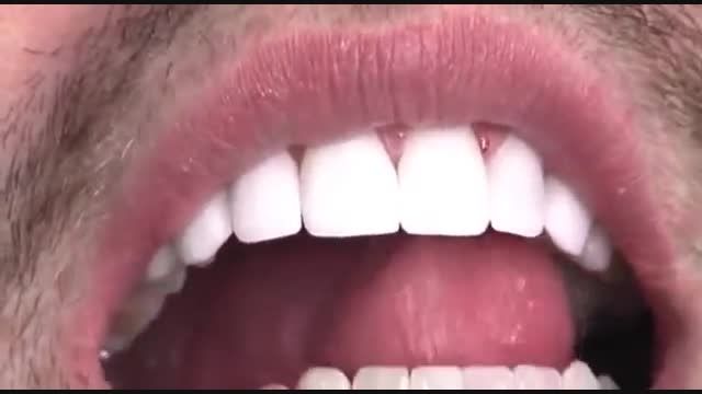 Cosmetic Dentistry San Antonio Prepless Veneers