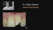 دندانپزشکی - باندینگ در دندانهای قدامی