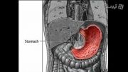 Stomach ulcer