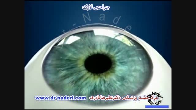 عمل لازک - مرکز چشم پزشکی دکتر علیرضا نادری