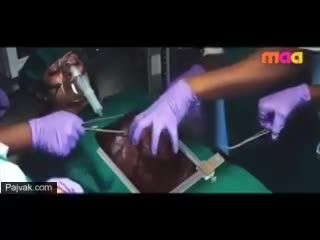 جدیدترین متد جراحی قلب هندی