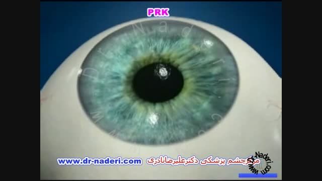 لیزر پی آر کی PRK - مرکز چشم پزشکی دکتر علیرضا نادری