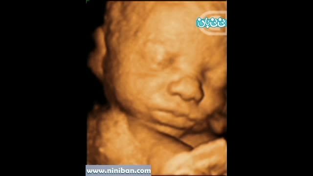 سونوگرافی چهار بعدی در بارداری هفته سی و یکم