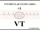 29 ‪ECGTeacher.com - Ventricular Tachycardia (Section 4_ Part 8)‬