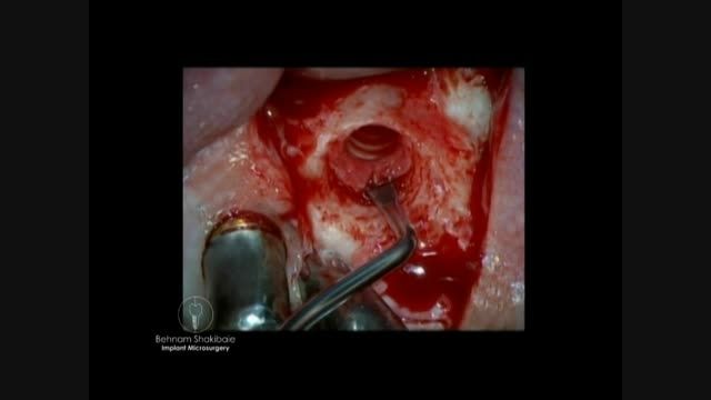 جراحی سینوس لیفت باز میکروسکوپی به سبک دکتر شکیبایی