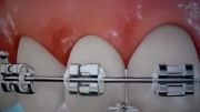 مراکز تخصصی ارتودنسی دکتر صدرالدینی : مسواک بین دندانی