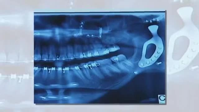 مردی با فک مصنوعی از جنس تیتانیوم توسط پرینتر سه بعدی