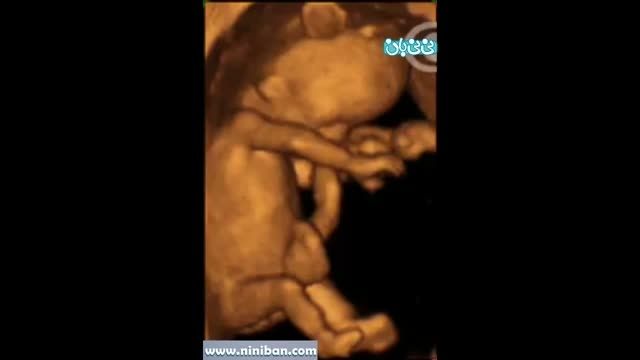 سونوگرافی چهار بعدی در بارداری هفته دهم(2)