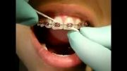 کشیدن نخ دندان در بیماران ارتودنسی