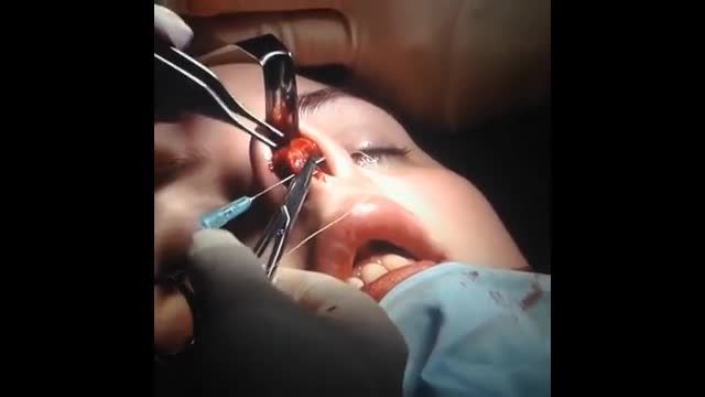 جراحی زیبایی بینی