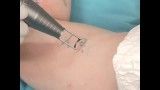 SPECTRA Tattoo Removal_ Fastest Q-Switched Laser Available 5-7ns_ Highest Peak Power