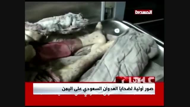 نخستین ویدئو از قربانیان تجاوز رژیم سعودی به یمن