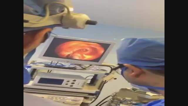 فیلم جراحی ادنوم هیپوفیز به روش آندسکوپی