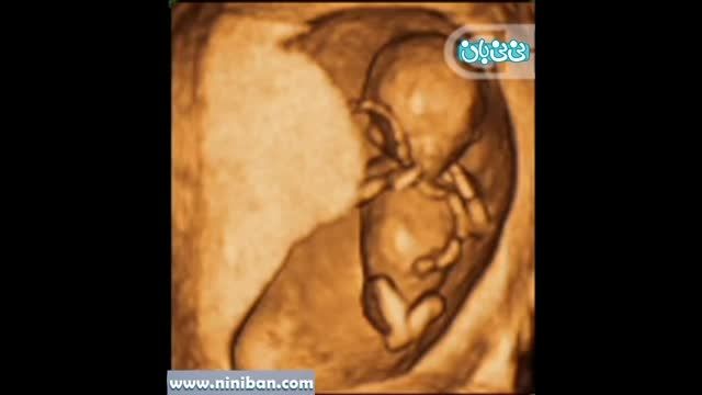 سونوگرافی چهار بعدی در بارداری هفته یازدهم(2)