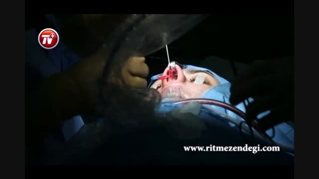 ویدئویی از جراحی سنگین بینی/قسمت دوم