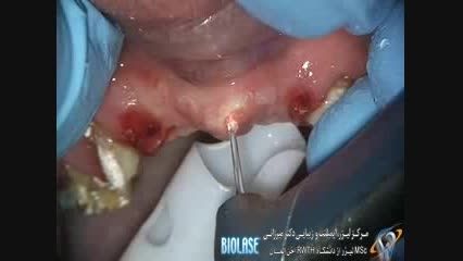 ضایعات هایپرپلاستیک التهابی در حفره دهانی