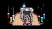 درمان ریشه دندان دندانپزشکی آبان