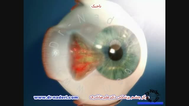 ناخنک - مرکز چشم پزشکی دکتر علیرضا نادری