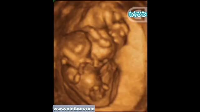 سونوگرافی چهار بعدی در بارداری هفته دهم(1)