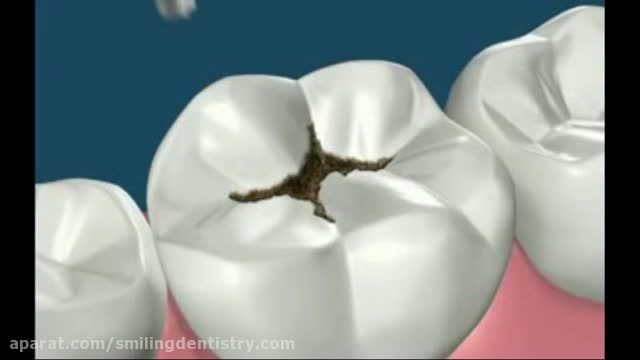 پر کردن دندان با مواد همرنگ دندان