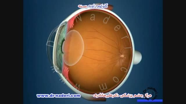 گلوکوم با زاویه تنگ - مرکز چشم پزشکی دکتر علیرضا نادری