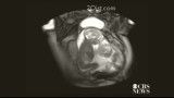 دوقلوهای شیطون قبل از تولد