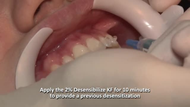 آموزش سفید کردن دندان - ویژه دانشجویان دندان پزشکی