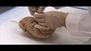 Georgia Centenarian Study- Brain Autopsy Program