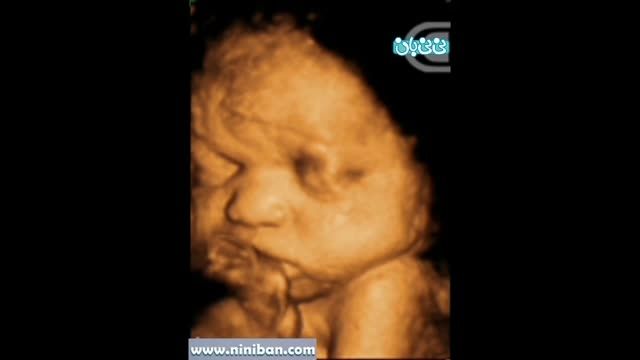 سونوگرافی چهار بعدی در بارداری هفته سی و سوم