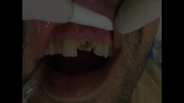 باز سازی دندان شکسته قدامی بالا با روکش زیرکونیوم