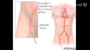 Directional coronary atherectomy (DCA)