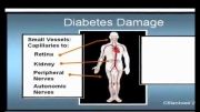 diabetic retinopathy 2