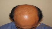 روش ترکیبی در کلینیک کاشت موی دکتر رضائی - قسمت 1