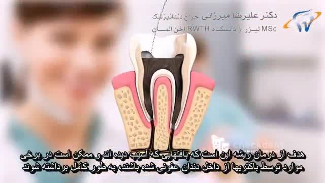 درمان ریشه یا روت کانال تراپی-انیمشن دندانپزشکی