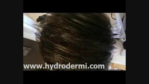دستگاه هیدرودرمی-تقویت مو