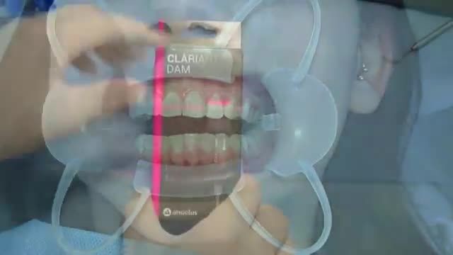 Angelus Clariant Dental Bleaching کیت بلیچینگ
