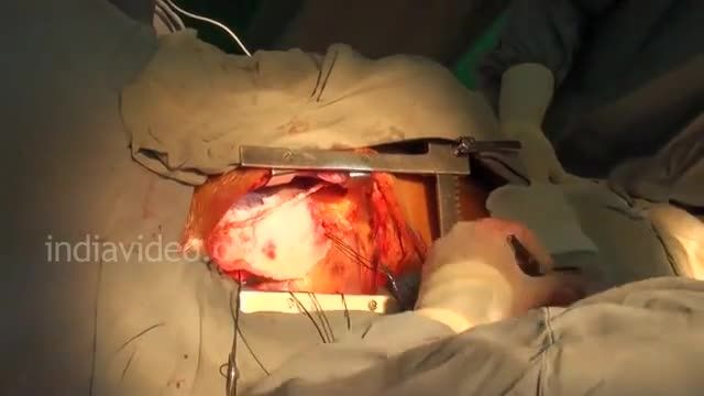 عمل جراحی قلب باز