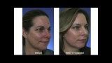 Acne-Scar-Treatment-with-Fractional-CO2-Laser