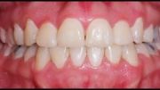 دکتر داودیان، عکس های قبل و بعد ارتودنسی نامرتبی دندان
