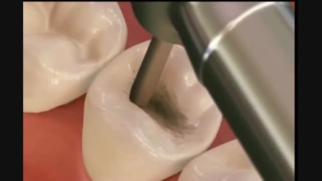 ترمیم پوسیدگی دندان ها با کامپوزیت (مواد همرنگ دندان)