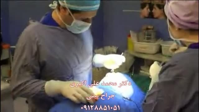 جراحی بینی-قسمت 1