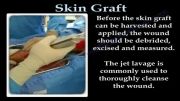 SKIN GRAFT - PART 1 . EVERYTHING YOU NEED TO KNOW - DR. NABI